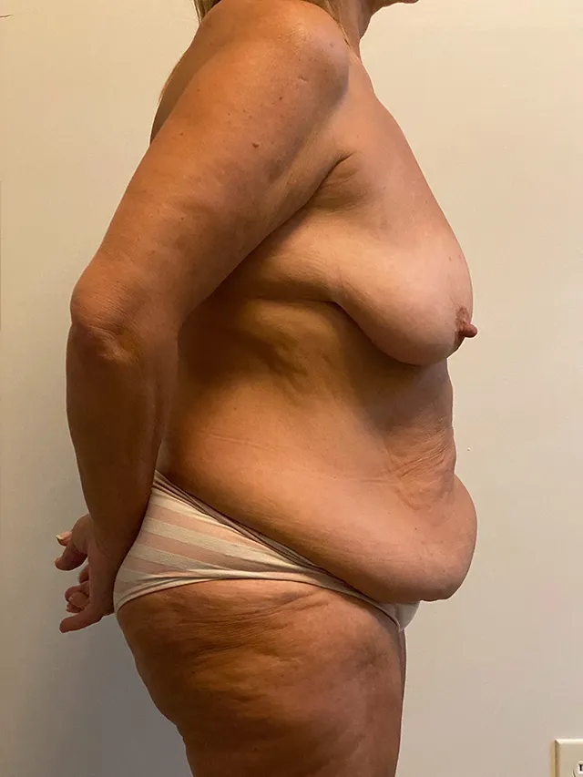 Mommy Makeover case #7929
