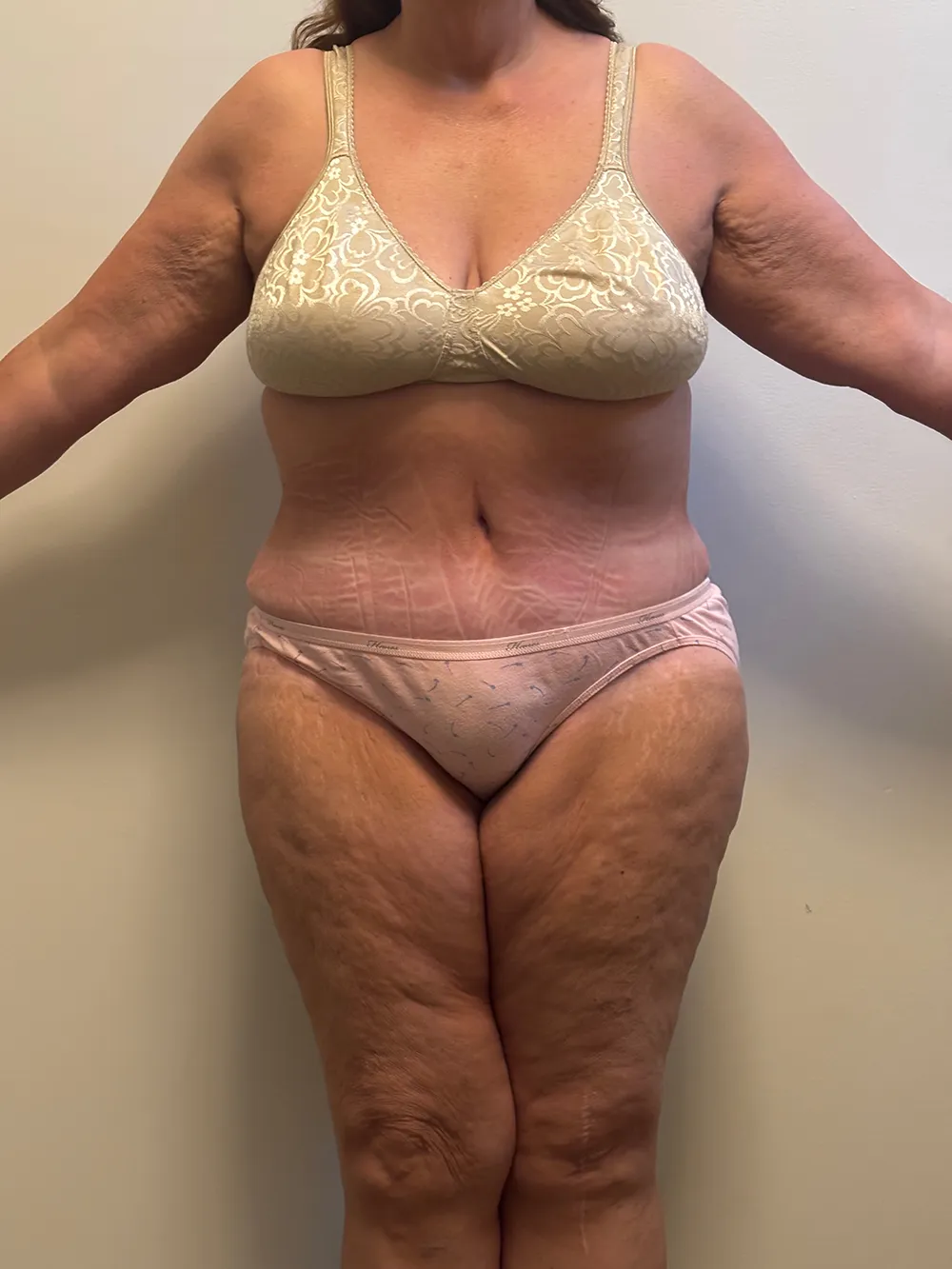 Tummy Tuck case #7746