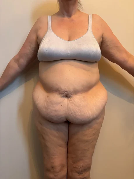 Tummy Tuck case #7746