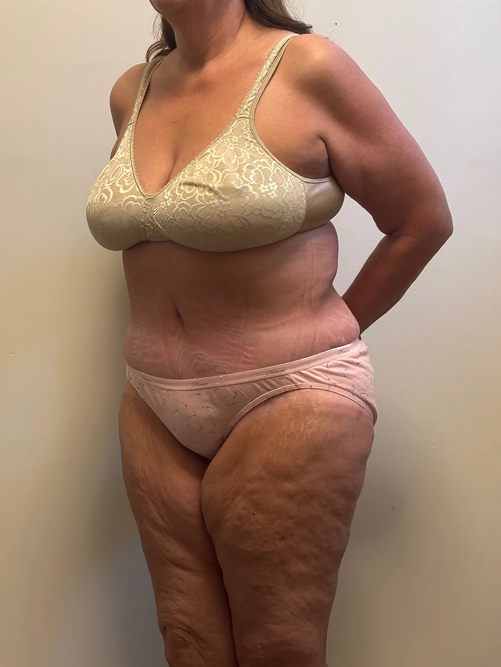 Tummy Tuck case #7746