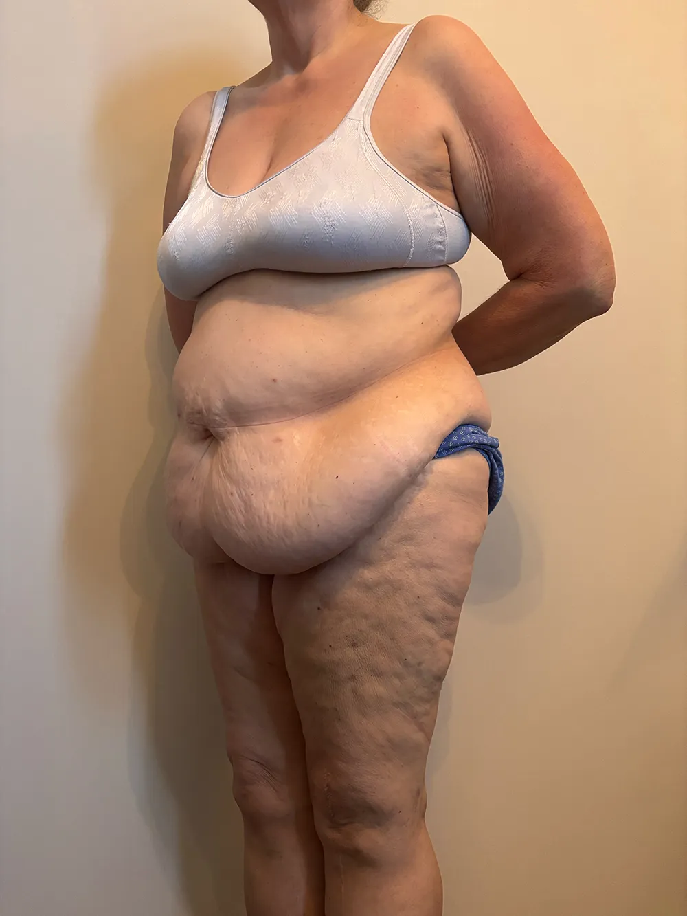 Tummy Tuck case #7746