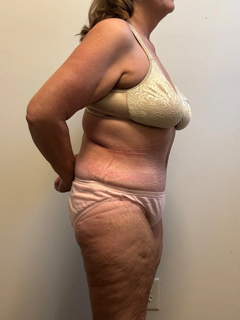Tummy Tuck case #7746