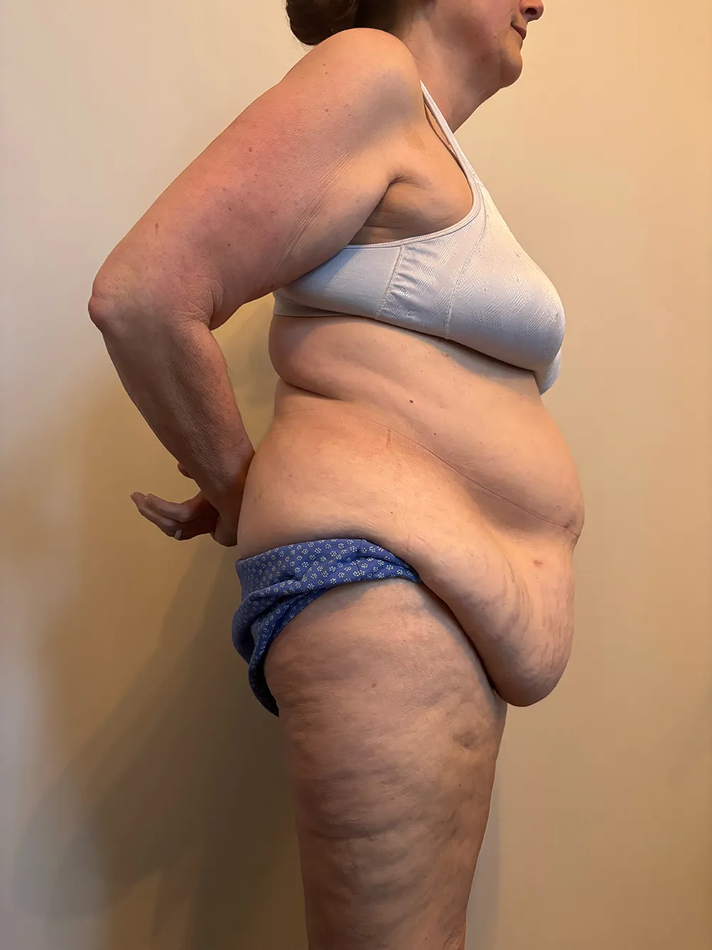Tummy Tuck case #7746